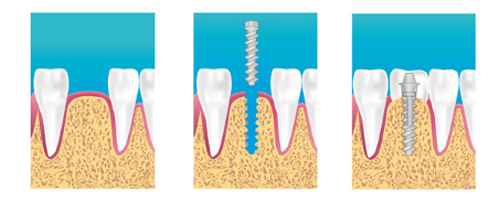 Implant dentaire Vincennes
